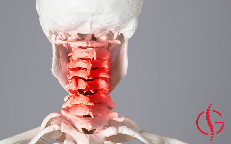 Neck diagram Diagram of cervical spine showing common whiplash injury areas including muscles, ligaments, and discs